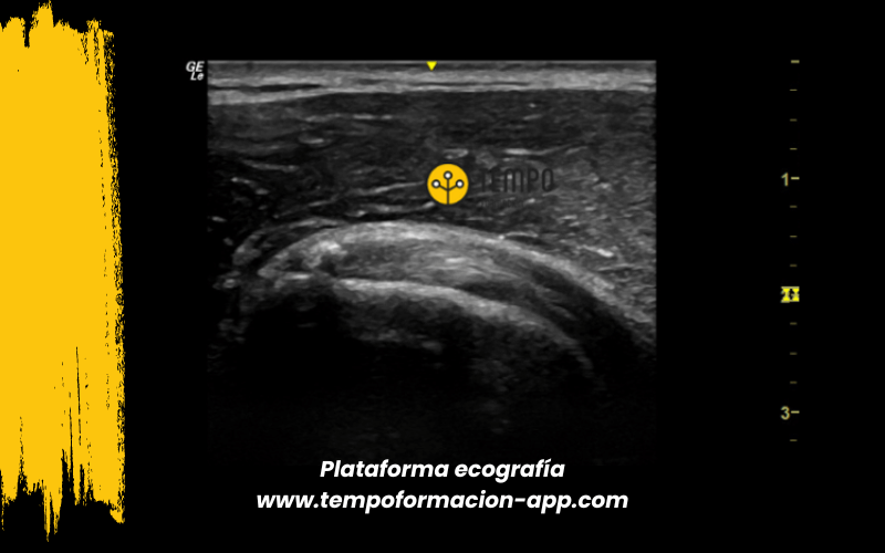 7. Ecografia tempo formacion manguito rotador tendon supraespinoso infraespinoso redondo menor subescapular.png